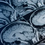 Pituitary Tumors: Unusual Growth in the Brain Pituitary Tumors: Unusual Growth in the Brain