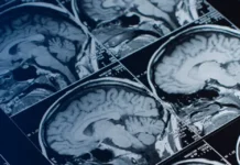 Pituitary Tumors: Unusual Growth in the Brain Pituitary Tumors: Unusual Growth in the Brain