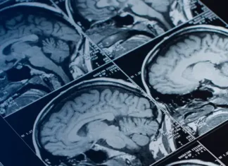 Pituitary Tumors: Unusual Growth in the Brain Pituitary Tumors: Unusual Growth in the Brain