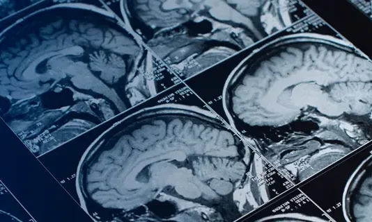 Pituitary Tumors: Unusual Growth in the Brain Pituitary Tumors: Unusual Growth in the Brain