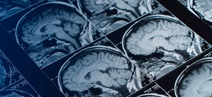 Pituitary Tumors: Unusual Growth in the Brain Pituitary Tumors: Unusual Growth in the Brain