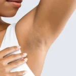 What Is Hidradenitis Suppurativa? Hidradenitis Suppurativa: Causes, Symptoms, and Treatment