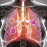 Neuroendocrine Tumors: Symptoms, Diagnosis, and Treatment Neuroendocrine Tumors: Symptoms, Diagnosis, and Treatment