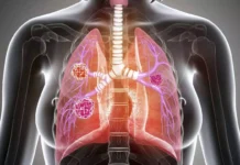 Neuroendocrine Tumors: Symptoms, Diagnosis, and Treatment Neuroendocrine Tumors: Symptoms, Diagnosis, and Treatment