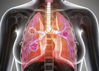 Neuroendocrine Tumors: Symptoms, Diagnosis, and Treatment Neuroendocrine Tumors: Symptoms, Diagnosis, and Treatment