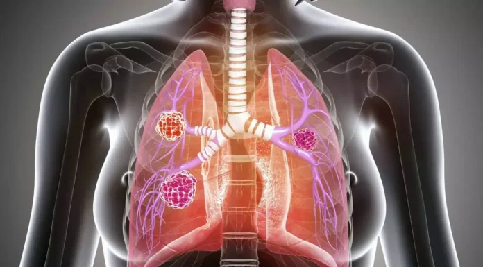 Neuroendocrine Tumors: Symptoms, Diagnosis, and Treatment Neuroendocrine Tumors: Symptoms, Diagnosis, and Treatment