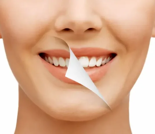 Are Porcelain Veneers the Best Choice for a Smile Makeover? Porcelain Veneers: Top Smile Makeover?