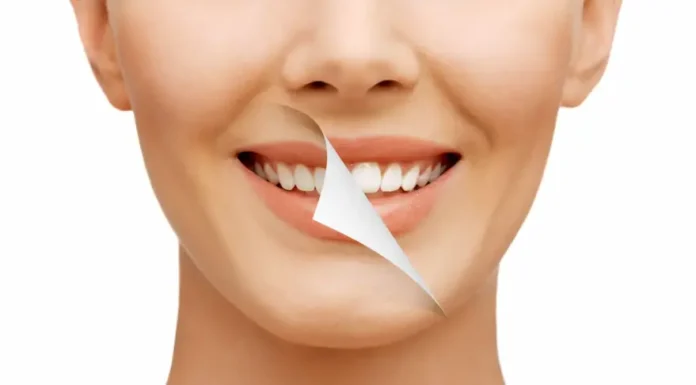 Are Porcelain Veneers the Best Choice for a Smile Makeover? Porcelain Veneers: Top Smile Makeover?