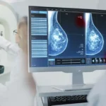 Inflammatory Breast Cancer (IBC): Diagnosis and Treatment Inflammatory Breast Cancer (IBC): Diagnosis and Treatment