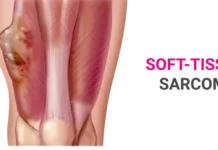 Sarcoma Treatment: Types, Causes, and Symptoms Sarcoma Treatment: Types, Causes, and Symptoms