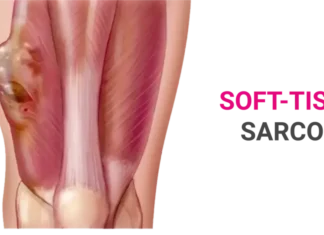 Sarcoma Treatment: Types, Causes, and Symptoms Sarcoma Treatment: Types, Causes, and Symptoms