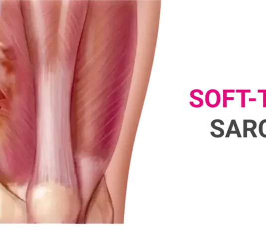 Sarcoma Treatment: Types, Causes, and Symptoms Sarcoma Treatment: Types, Causes, and Symptoms