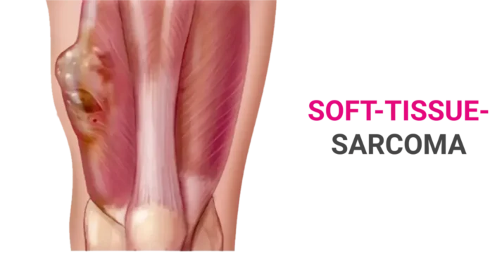 Sarcoma Treatment: Types, Causes, and Symptoms
