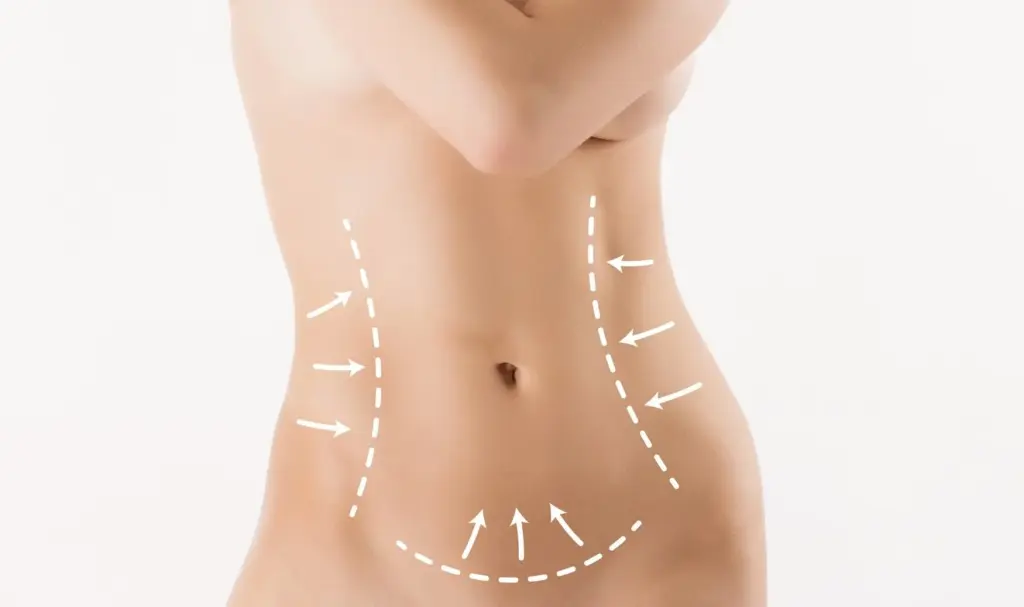 Liposuction: What to Know—Expert Insights and Guidance
