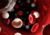 Leukaemia: Causes, Symptoms, Diagnosis, and Treatment Leukaemia: Causes, Symptoms, Diagnosis, and Treatment