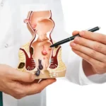 Hemorrhoids: Swollen veins in the rectum and anus Hemorrhoids: Swollen Veins in the Rectum and Anus—Symptoms