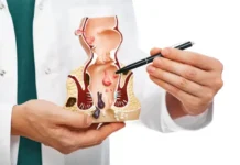 Hemorrhoids: Swollen veins in the rectum and anus Hemorrhoids: Swollen Veins in the Rectum and Anus—Symptoms