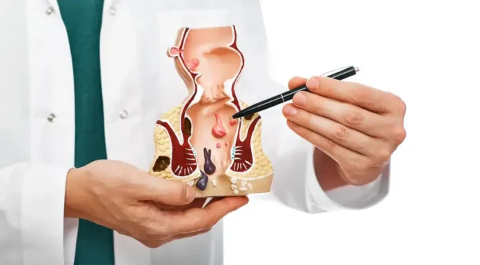 Hemorrhoids: Swollen veins in the rectum and anus Hemorrhoids: Swollen Veins in the Rectum and Anus—Symptoms